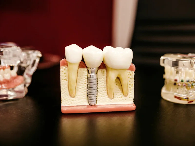 Modelo de implante dentário com coroa sobre a arcada